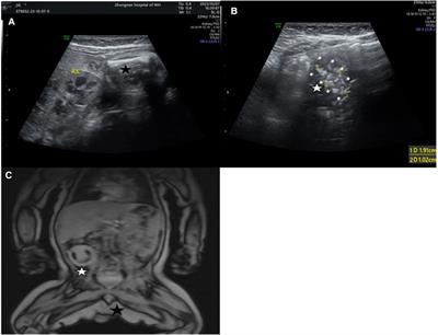 An infant with testicular Fetus-in-fetu in the abdominal cavity: rare case report